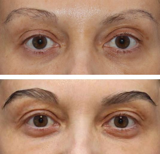  Before and After Picture 
47 year old female, 6 months after one hair transplant to brows.