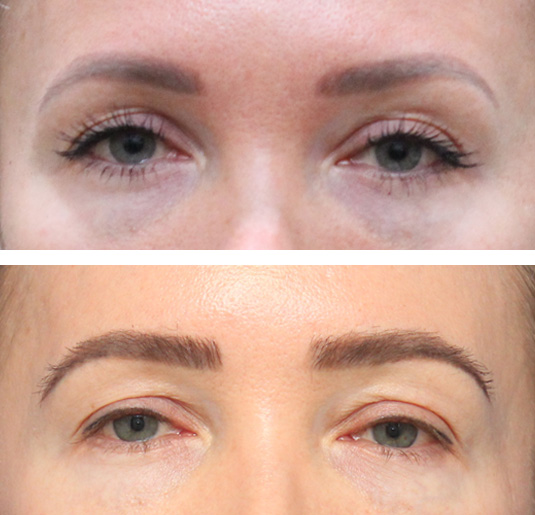  Before and After Picture 
40 year old female, 1 year after one hair transplant to brows.