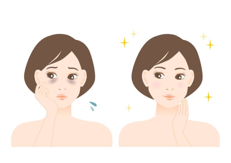 Can You Permanently Remove Dark Circles? McCracken Blog