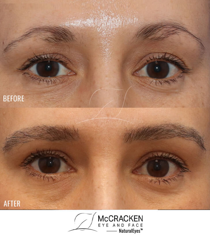 43 year old female, 6 months after one hair transplant to brows.
