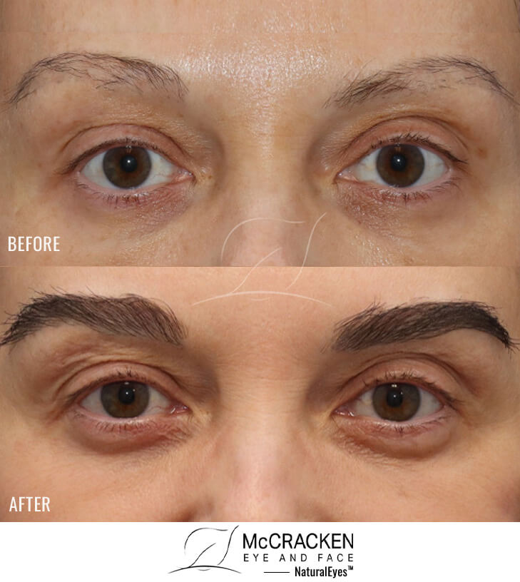 47 year old female, 1 year after one hair transplant to brows.