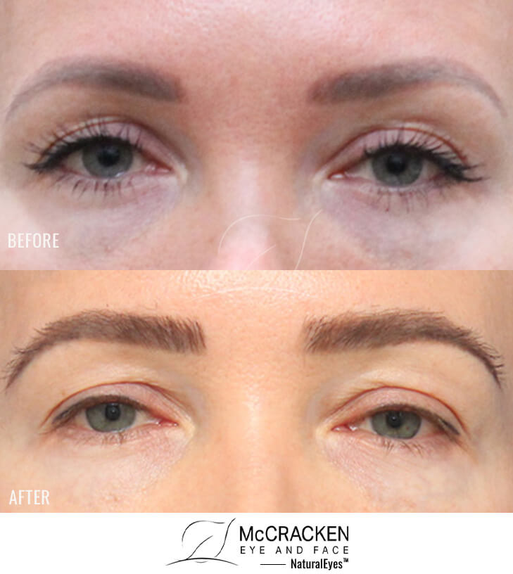 40 year old female, 1 year after one hair transplant to brows.
