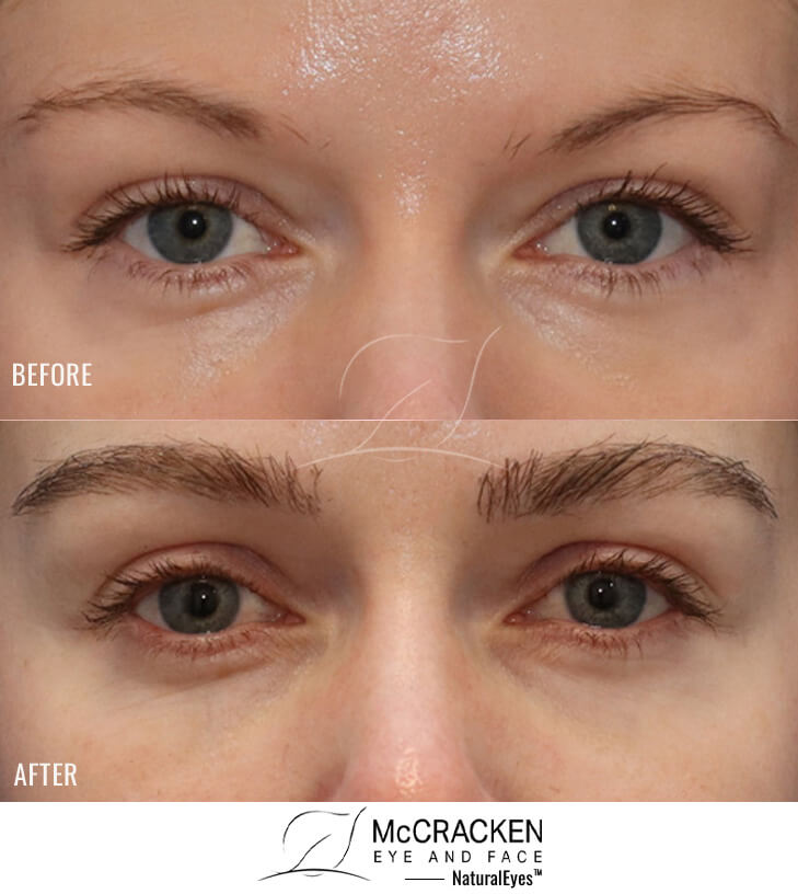 31 year old female, 1 year after one hair transplant to the brows.