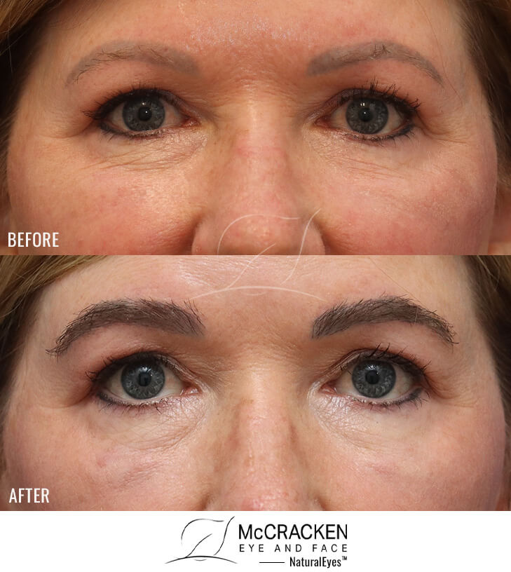 54 year old female 1 year after one hair transplant to brows.