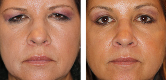  Before and After Picture 
46 year old female - Full face fractional CO2 laser skin resurfacing, Endoscopic brow lift