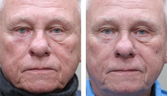  Before and After Picture 
78 Year Old Male – Repair of Right Lower Lid Retraction After Unsatisfactory Skin Cancer Repair elsewhere
