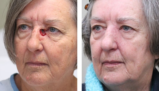  Before and After Picture 
72 Year Old Female - Repair of Mohs Defect after Excision of Basal Cell Carcinoma.