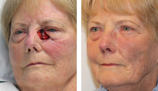  Before and After Picture 
78 year old female – Repair of left lower lid, medial canthal, and nose  Mohs defect after excision of basal cell carcinoma.