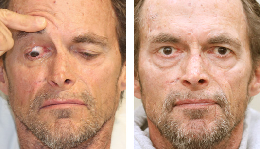  Before and After Picture 
56 year old male - repair of right upper lid defect after Mohs excision of basal cell carcinoma.