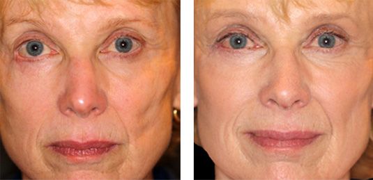  Before and After Picture  
67 Year Old Female - Repair of Lower Lid Retraction