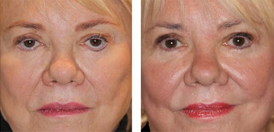  Before and After Picture  
70 Year Old Female - Repair of Lower Lid Retraction After Unsatisfactory Blepharoplasty