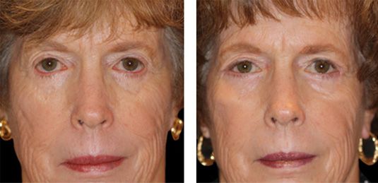  Before and After Picture  
77 Year Old Female - Repair of Lower Lid Retraction After Unsatisfactory Blepharoplasty