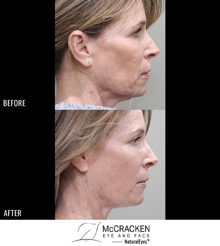 57 Year Old Female – Facetite and Morpheus8 to Neck and Jowls