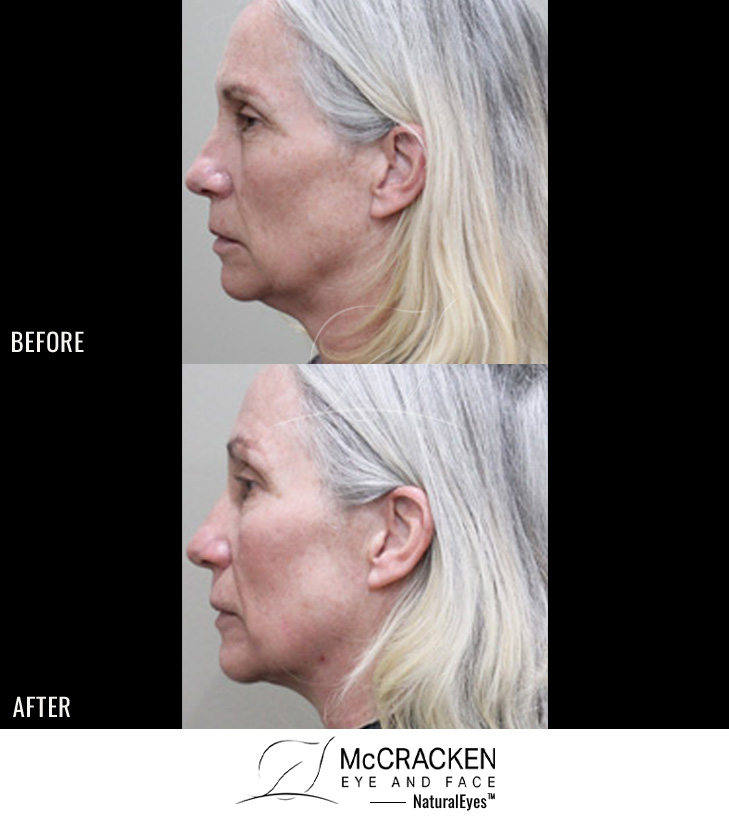 61 Year Old Female – FaceTite and Morpheus8 to Neck and Jowls