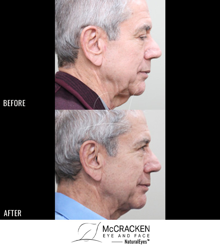 74 Year Old Male – FaceTite and Morpheus8 to the Neck and Jowls