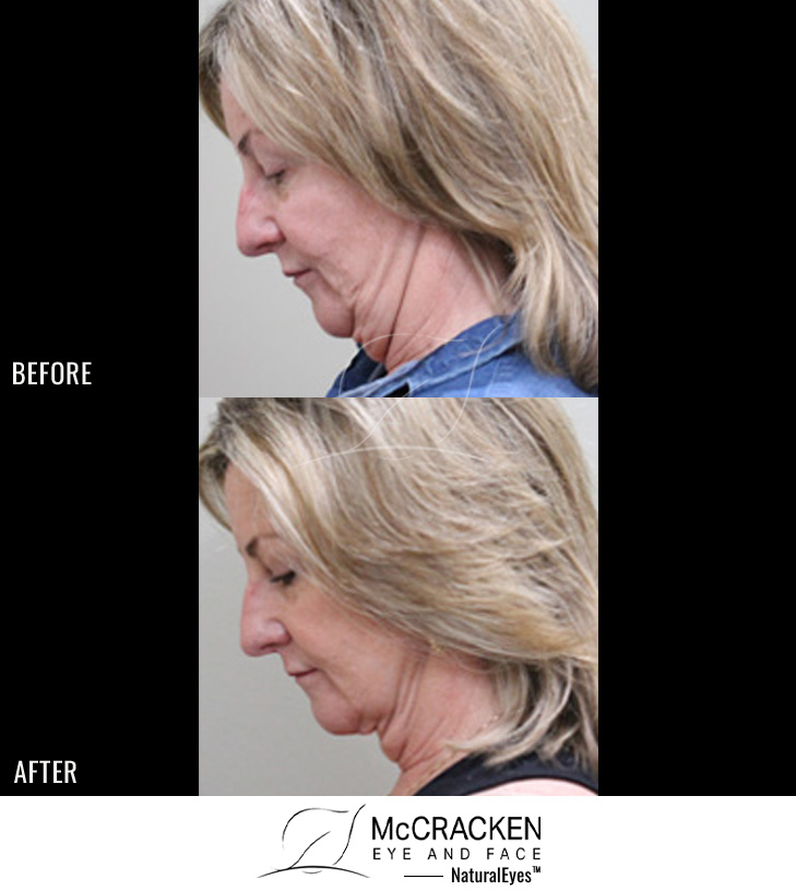 61 Year Old Female – FaceTite to the Neck and Jowls with MyEllevate Neck Suspension