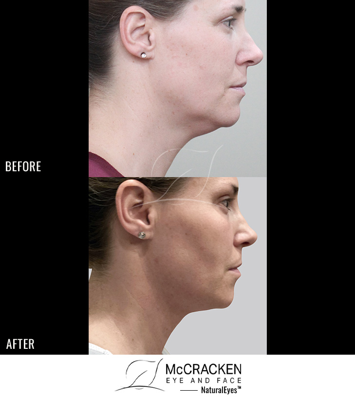 45 year old female – FaceTite to the neck and jowls and Morpheus8 (RF microneedling) to the face and neck
