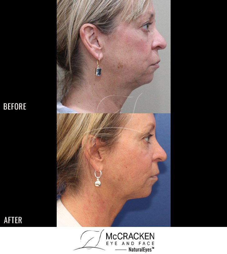 55 Year Old Female – Facetite and Morpheus8 to Neck and Jowls