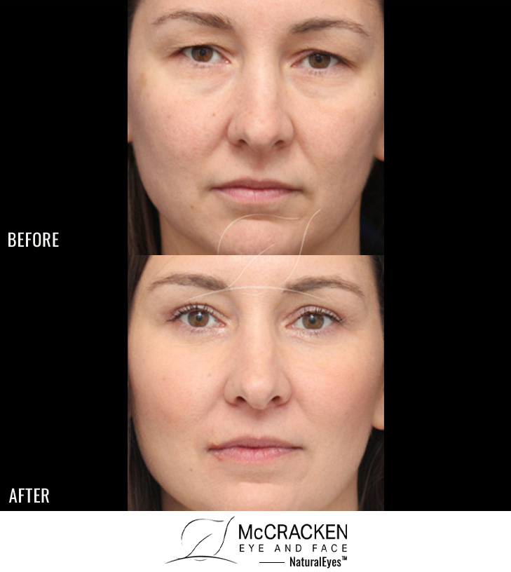 43 Year Old Female – Upper and Lower Lid Blepharoplasty with Injection of 4cc of Fat to Each Cheek and Tear Trough and Laser Skin Resurfacing. No Lower Lid Skin Incisions were made, and lower lid fat was excised but not repositioned.