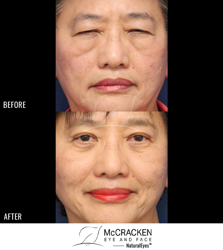 43 Year Old Female – Upper and Lower Lid Blepharoplasty with Injection of 4cc of Fat to Each Cheek. No Lower Lid Skin Incisions were made, and lower lid fat was excised and repositioned.
