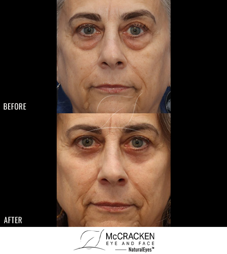 63 Year Old Female – Bilateral Lower Lid Blepharoplasty Injection of 3.5cc of Fat to Each Cheek, and Laser Skin Resurfacing. No Lower Lid Skin Incisions were made.