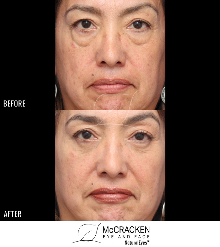 60 Year Old Female – Lower Lid Blepharoplasty with Injection of 4.0cc of Fat to Each Cheek. No Lower Lid Skin Incisions were made.