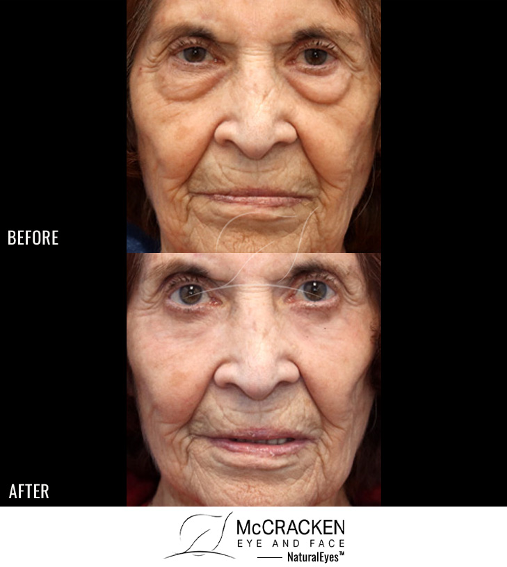 86 Year Old Female – Upper and Lower Blepharoplasty (with Lower Lid Skin Excision) with Fat Injection (5cc on the Right and 6cc on the Left) and Periocular Laser Skin Resurfacing.