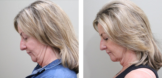  Before and After Picture 
61 Year Old Female - FaceTite to the Neck and Jowls with MyEllevate Neck Suspension
