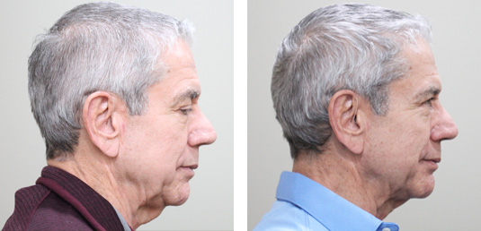  Before and After Picture 
74 Year Old Male - FaceTite and Morpheus8 to the Neck and Jowls