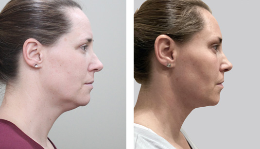  Before and After Picture 
45 year old female – FaceTite to the neck and jowls and Morpheus8 (RF microneedling) to the face and neck
