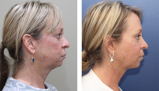  Before and After Picture 
55 Year Old Female – Facetite and Morpheus8 to Neck and Jowls