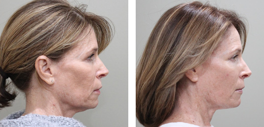  Before and After Picture 
57 Year Old Female - Facetite and Morpheus8 to Neck and Jowls
