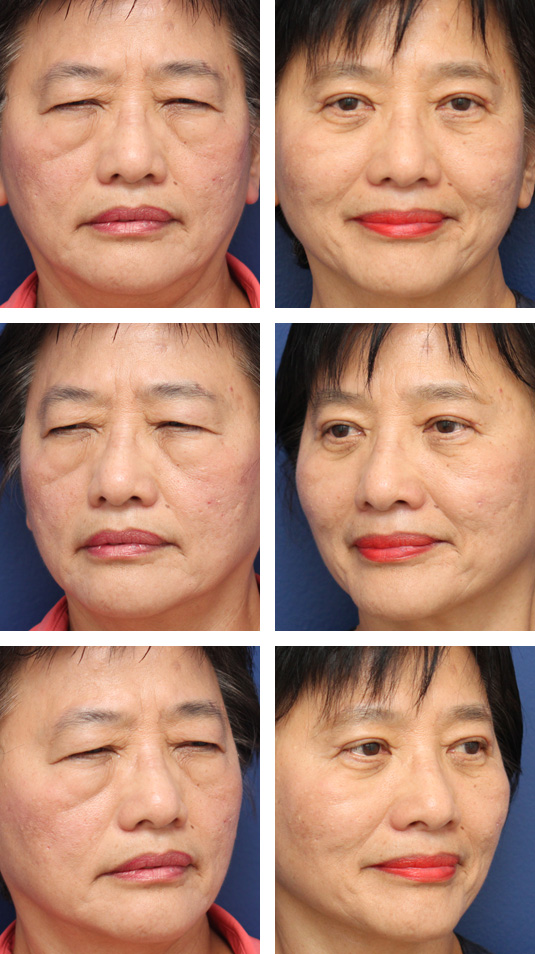  Before and After Picture 
43 Year Old Female – Upper and Lower Lid Blepharoplasty with Injection of 4cc of Fat to Each Cheek. No Lower Lid Skin Incisions were made, and lower lid fat was excised and repositioned.