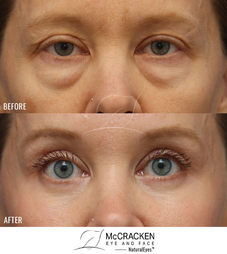 44 Year Old Female Upper and Lower Lid Blepharoplasty with Injection of 4cc of Fat to Each Cheek, and Laser Skin Resurfacing.