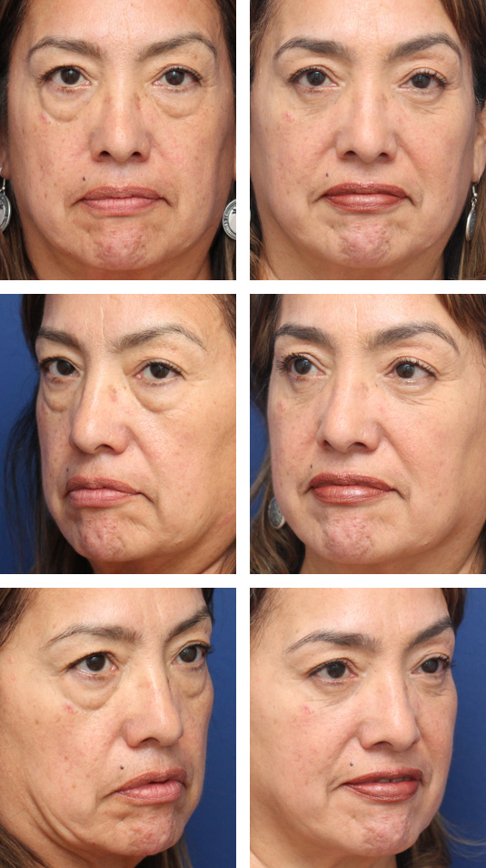  Before and After Picture 
60 Year Old Female – Lower Lid Blepharoplasty with Injection of 4.0cc of Fat to Each Cheek. No Lower Lid Skin Incisions were made.