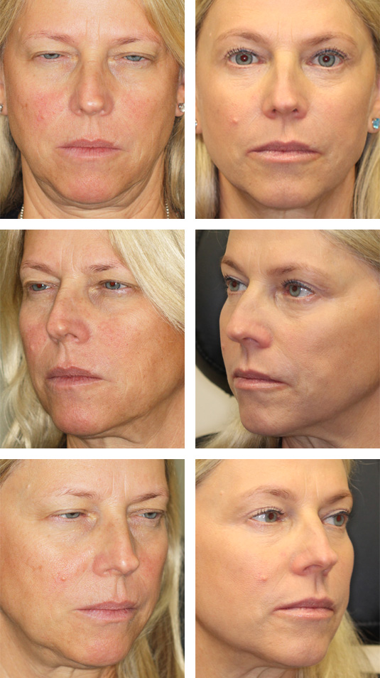 Before and After Picture 
54 Year Old Female – Brow Lift, Upper and Lower Blepharoplasty, and Periocular Laser Skin Resurfacing