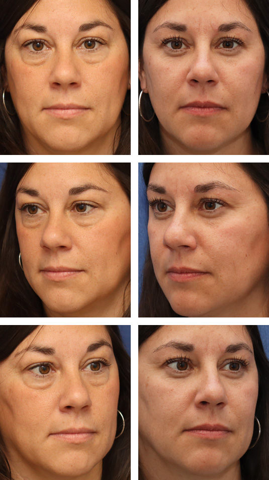  Before and After Picture 
42 Year Old Female – Lower Blepharoplasty with AccuTite Radiofrequency Treatment. No lower lid skin incisions were made.