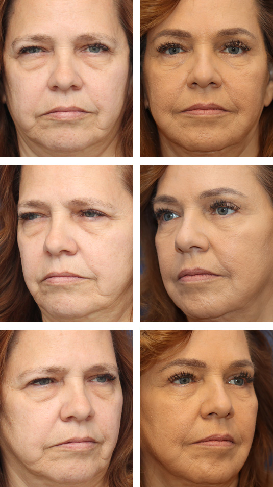  Before and After Picture 
62 Year Old Female – Endoscopic Brow Lift with Right upper Lid Fat Removal, Lower Blepharoplasty and Laser Skin Resurfacing. The brow lift was fixated with EndoTines. No lower lid skin incisions were made.