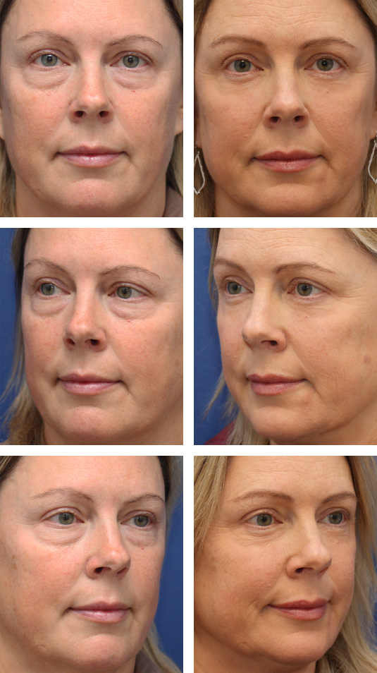  Before and After Picture 
48 Year Old Female – Lower Blepharoplasty with Periocular Laser Skin Resurfacing. No lower lid skin incisions were made.