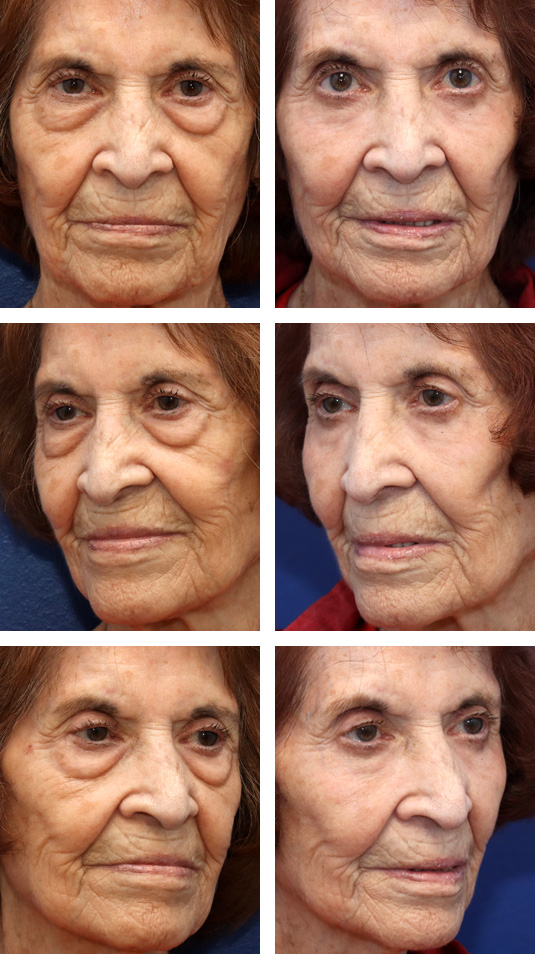  Before and After Picture 
86 Year Old Female – Upper and Lower Blepharoplasty (with Lower Lid Skin Excision) with Fat Injection (5cc on the Right and 6cc on the Left) and Periocular Laser Skin Resurfacing.