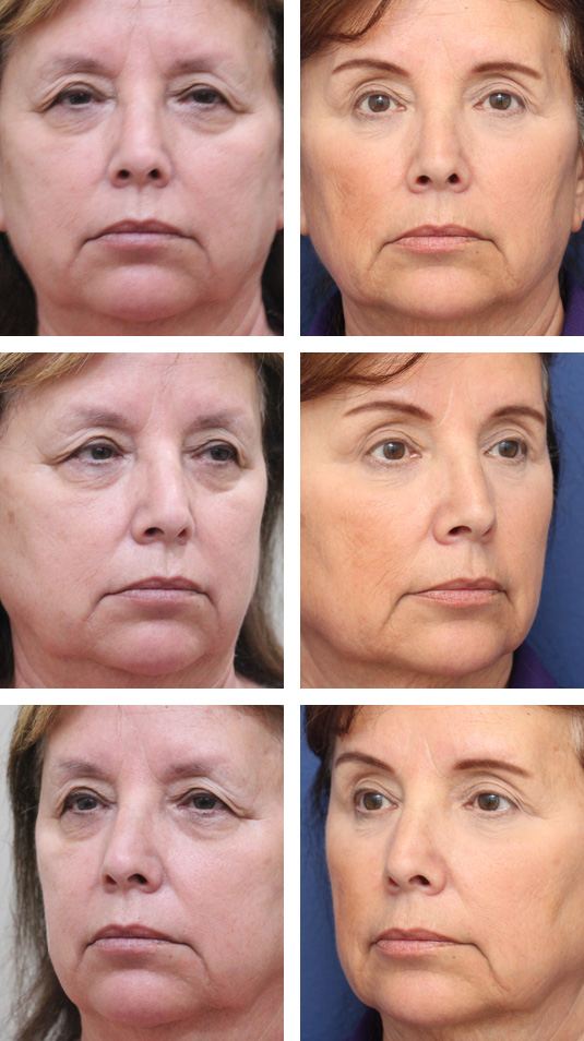  Before and After Picture 
69 Year Old Female – Upper and Lower Blepharoplasty with Bilateral Upper Lid Ptosis Repair, Bilateral Temporal Brow Lift, and Periocular Laser Skin Resurfacing. No lower lid skin incisions were made.