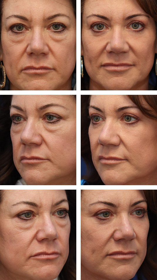  Before and After Picture 
50 Year Old Female – Upper and Lower Lid Blepharoplasty with skin pinch excision with Injection of 5cc of Fat to Each Cheek and Laser Skin Resurfacing.