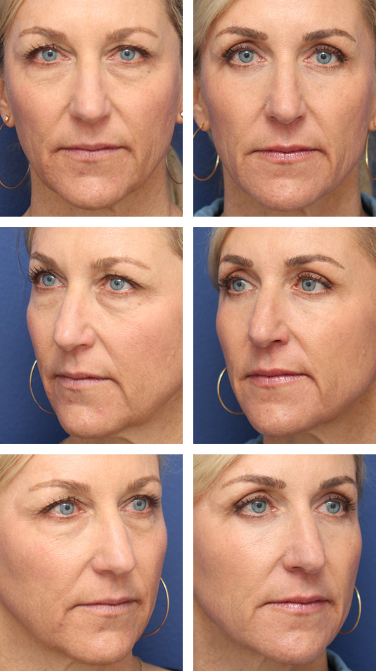  Before and After Picture 
51 Year Old Female – Upper and Lower Blepharoplasty with Periocular Laser Skin Resurfacing. No lower lid skin incisions were made.