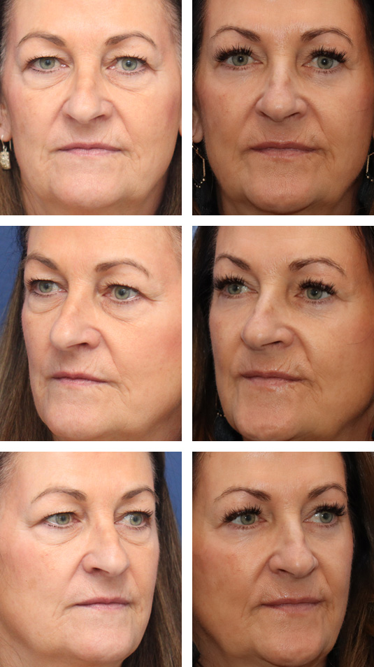  Before and After Picture 
57 Year Old Female – Upper and Lower Blepharoplasty with Periocular Laser Skin Resurfacing. No lower lid skin incisions were made.
