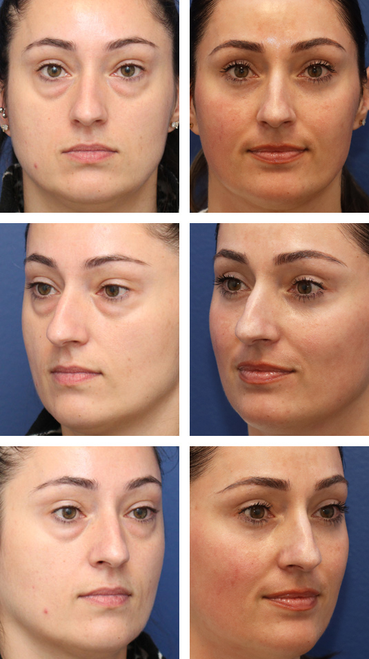  Before and After Picture 
36 Year Old Female – Lower Lid Blepharoplasty with Fat Repositining, Injection of 4cc of Fat to Each Cheek and Laser Skin Resurfacing. No Lower Lid Skin Incisions were made.