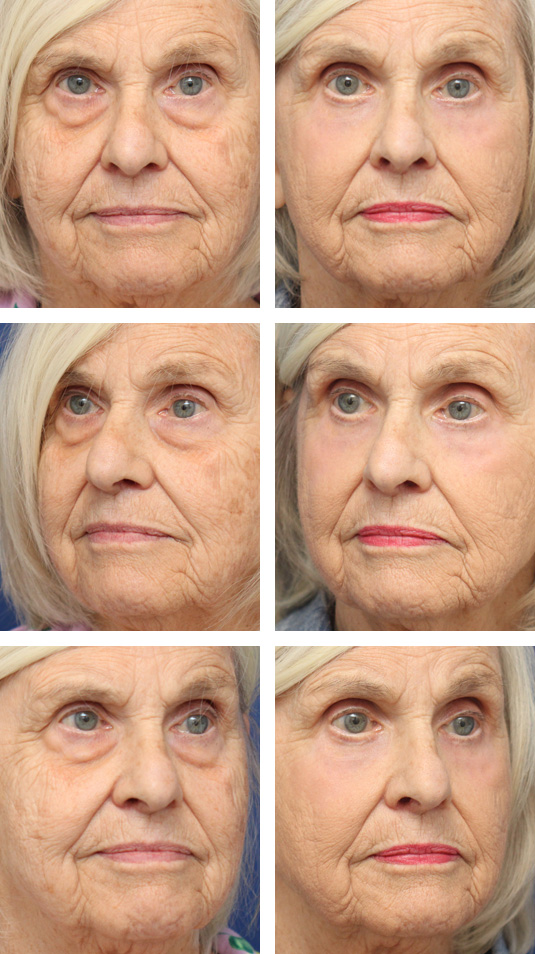  Before and After Picture 
79 Year Old Female – Lower Blepharoplasty with Periocular Laser Skin Resurfacing and Morpheus8 to the Cheeks. No lower lid skin incisions were made.