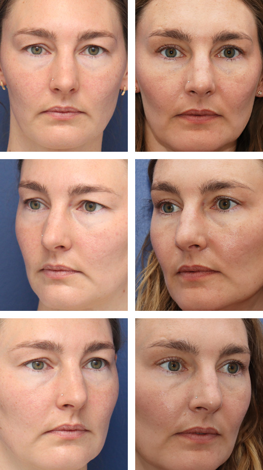  Before and After Picture 
37 Year Old Female – Upper Blepharoplasty with Right Upper Lid Ptosis Repair