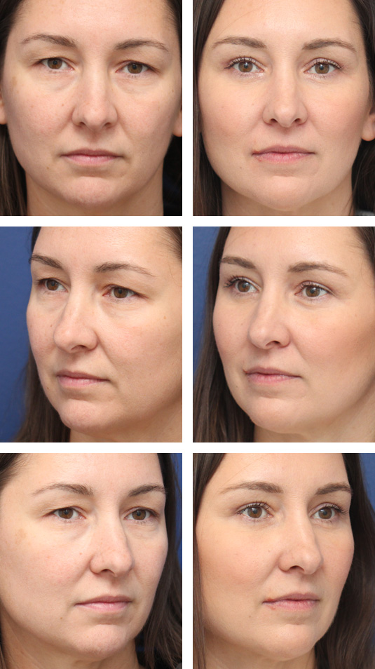  Before and After Picture 
43 Year Old Female – Upper and Lower Lid Blepharoplasty with Injection of 4cc of Fat to Each Cheek and Tear Trough and Laser Skin Resurfacing. No Lower Lid Skin Incisions were made, and lower lid fat was excised but not repositioned.