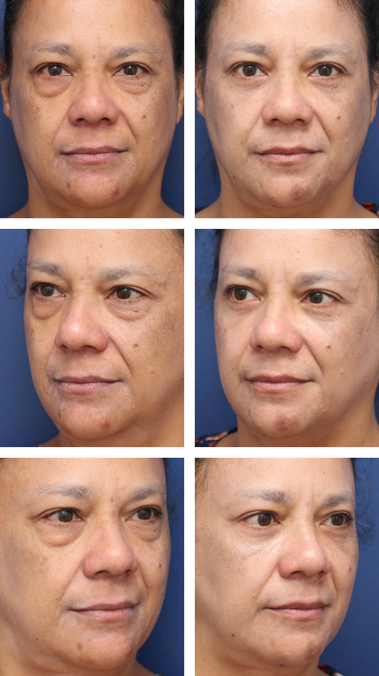  Before and After Picture 
53 Year Old Female – Lower Blepharoplasty. No lower lid skin incisions were made.
