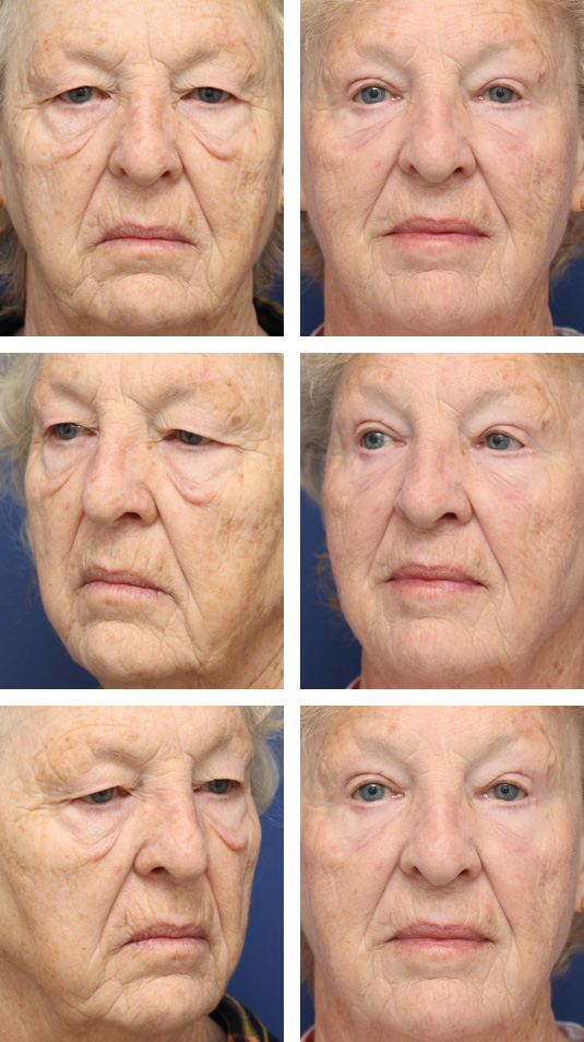  Before and After Picture 
73 Year Old Female – Upper and Lower Blepharoplasty with Direct Excision of Festoons and Periocular Laser Skin Resurfacing. Because this patient had festoons (folded over skin and muscle on the cheek just below the lower lid) she had excision of the redundant tissue below the lower lid.